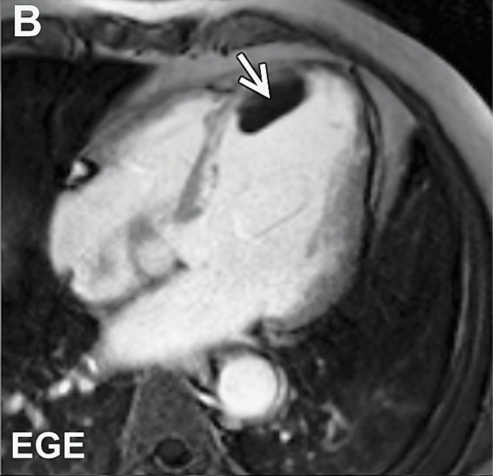 Left ventricular thrombus